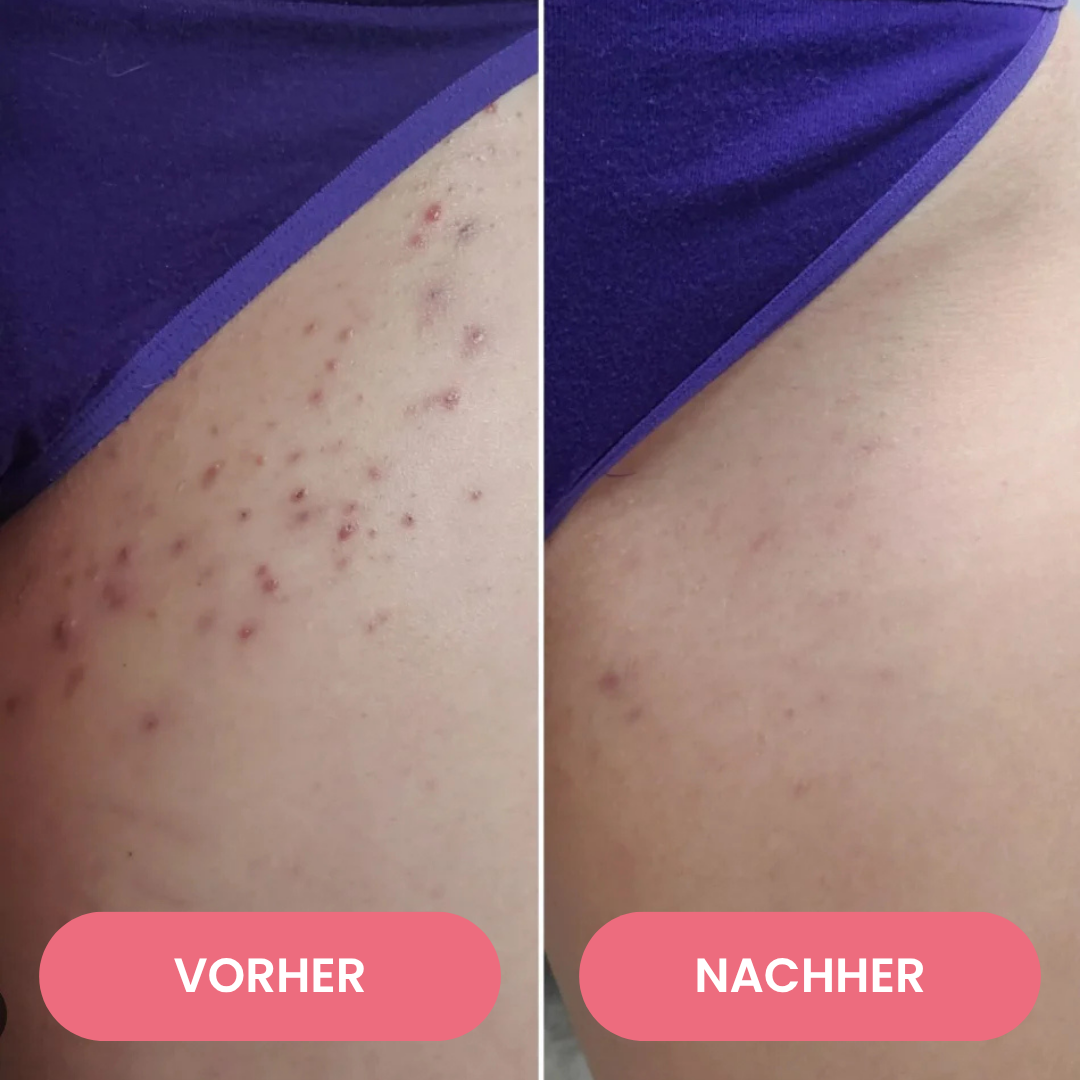 SmoothTrim™ - 2in1 schmerzfreier Dual-Trimmer