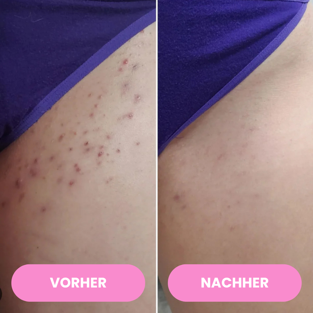 SmoothTrim - 2in1 schmerzfreier Dual-Trimmer